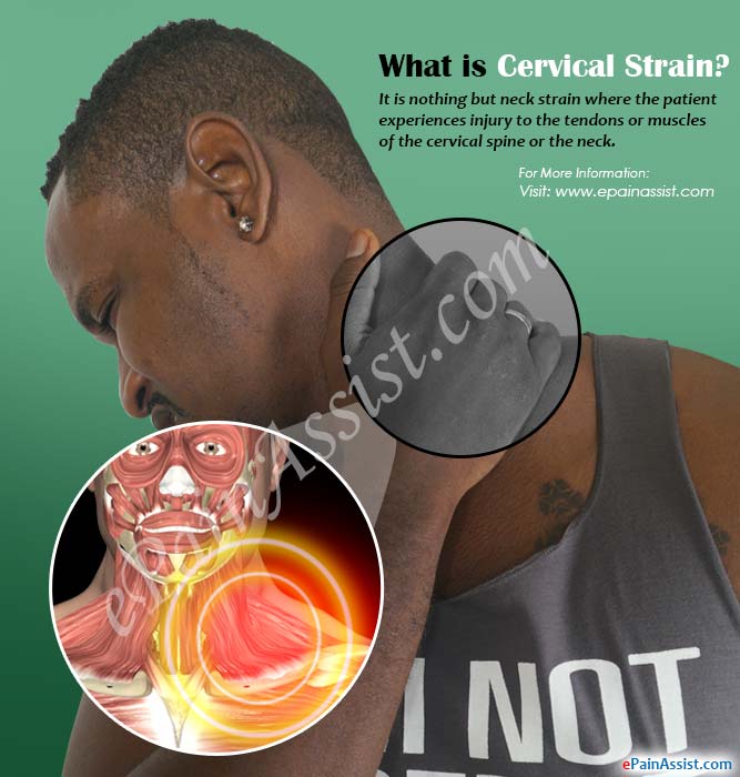 What is Cervical Strain?