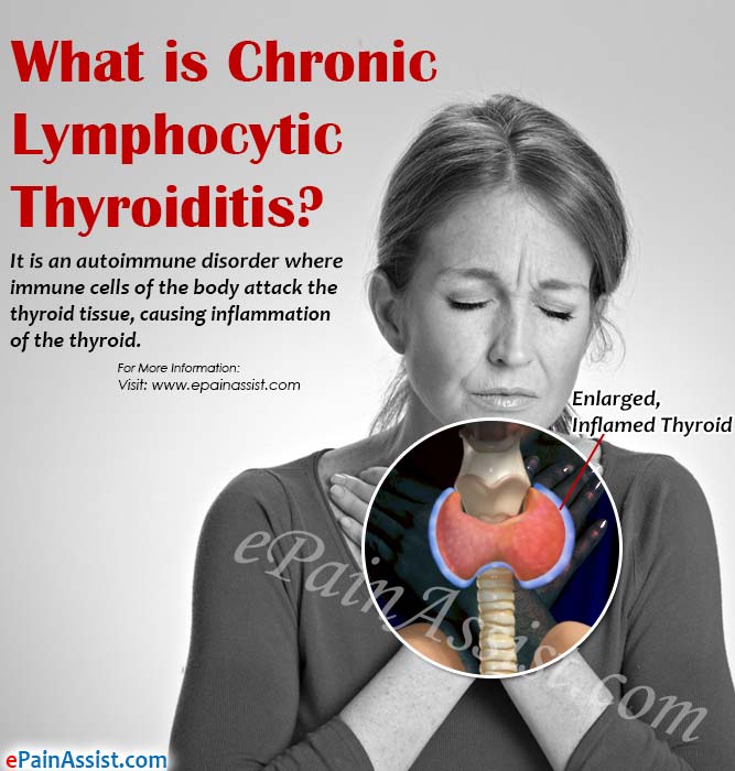 What is Chronic Lymphocytic Thyroiditis?