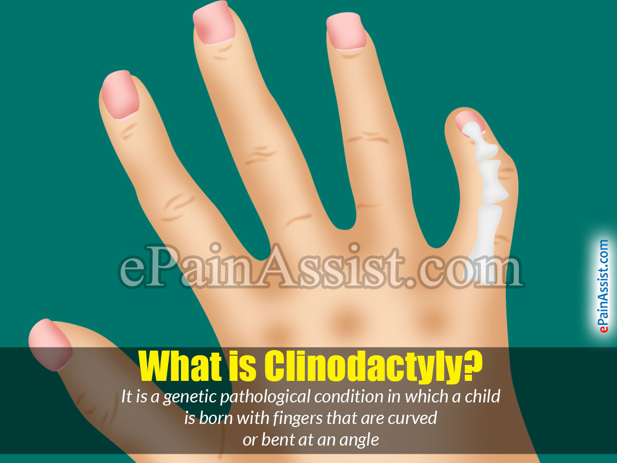 What is Clinodactyly? What is Clinodactyly?
