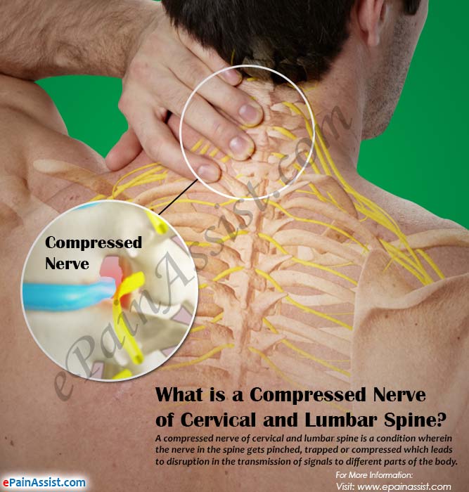 What is a Compressed Nerve of Cervical and Lumbar Spine?