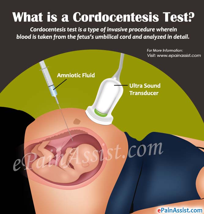 What is a Cordocentesis Test?