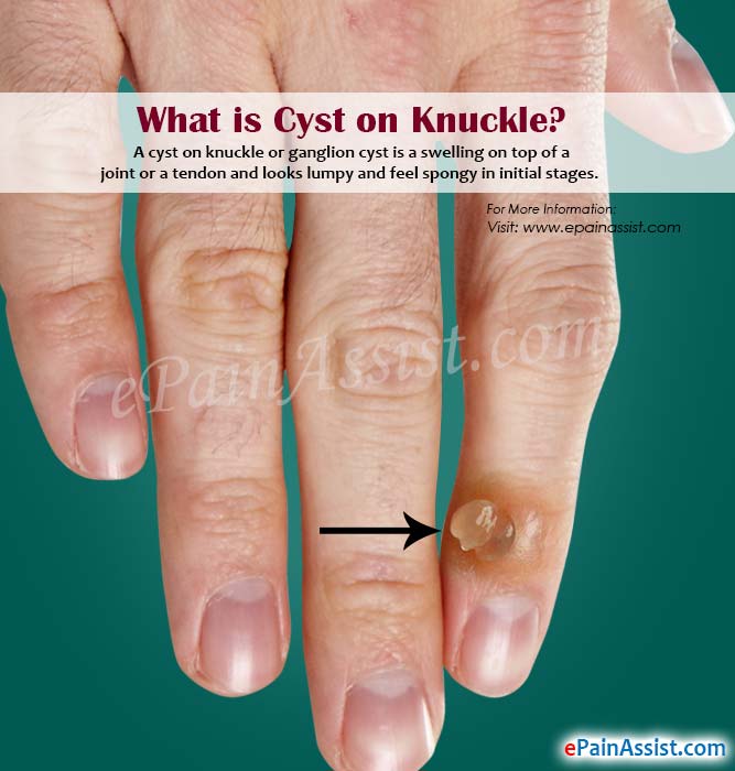 What is Cyst on Knuckle?