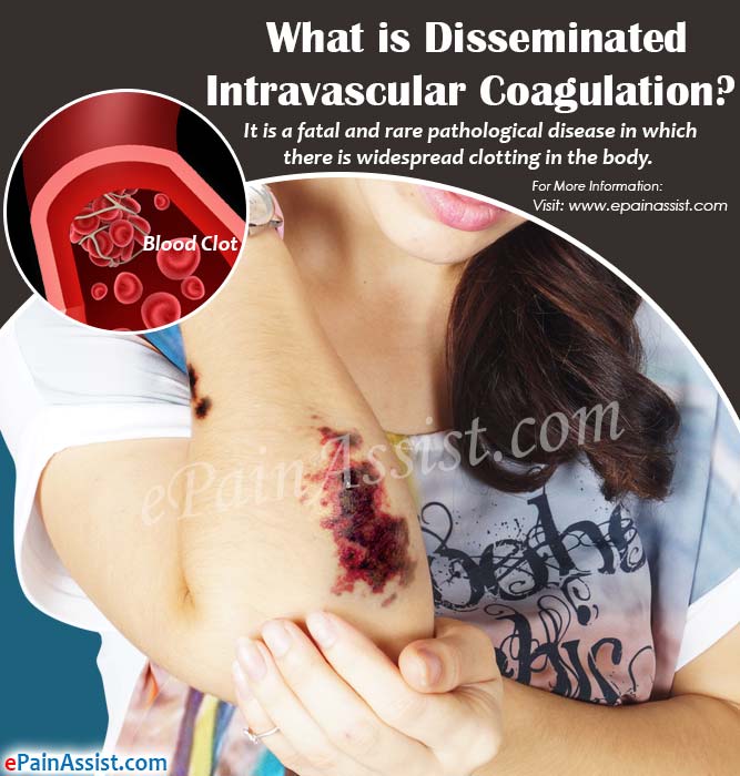 What is Disseminated Intravascular Coagulation?