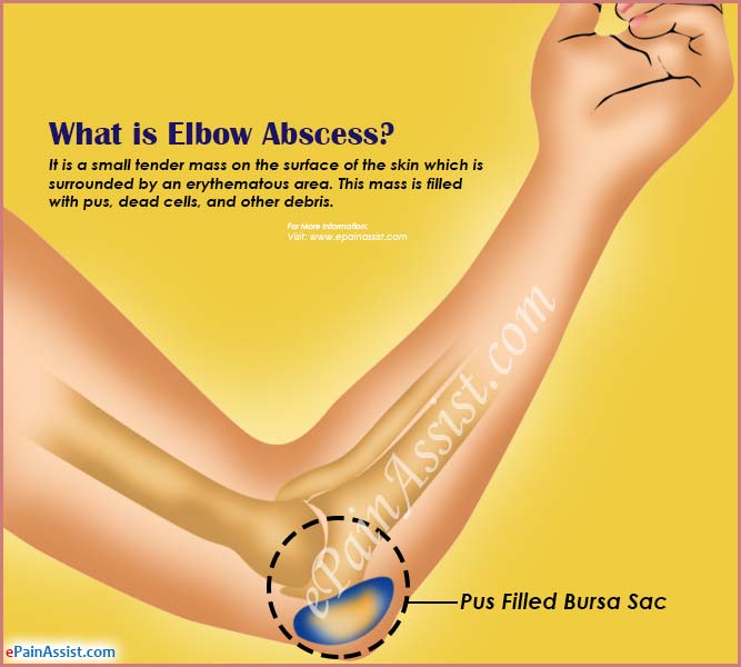 What is Elbow Abscess?