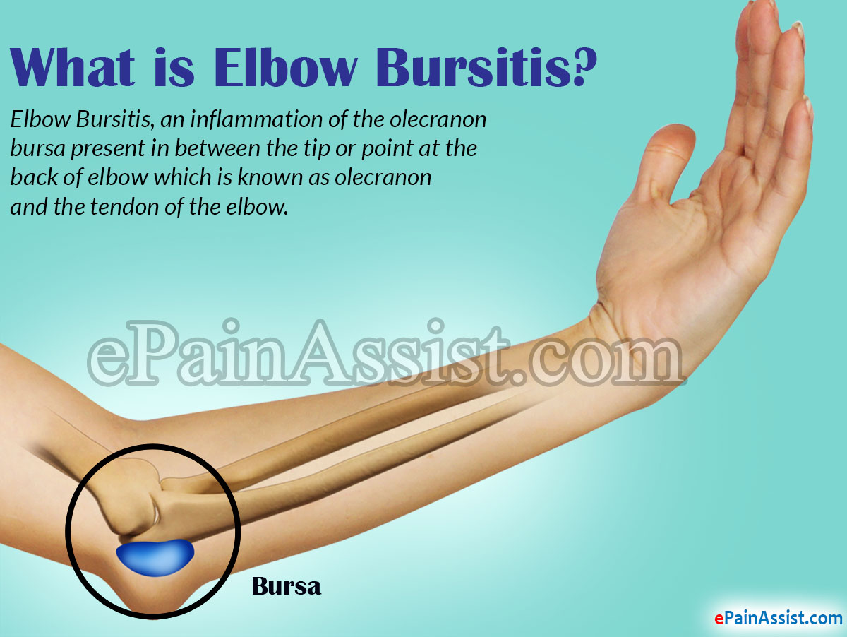 What is Elbow Bursitis? What is Elbow Bursitis?