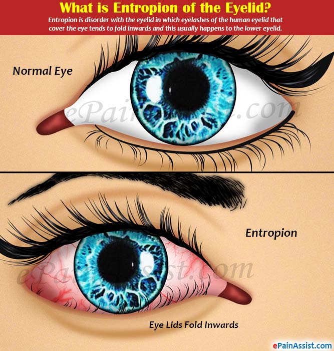 How Is Entropion Treated