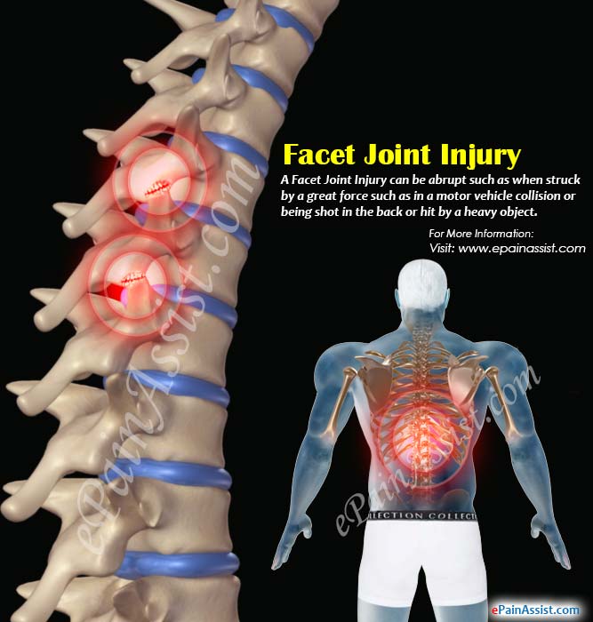 What is Facet Joint Injury What is Facet Joint Injury