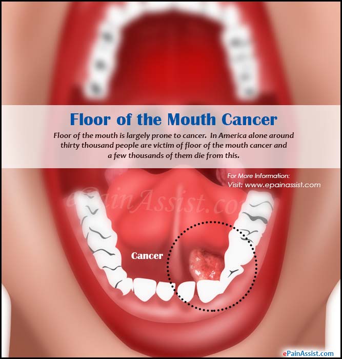 Floor Of The Mouth Cancer Causes Symptoms Treatment Survival Rate