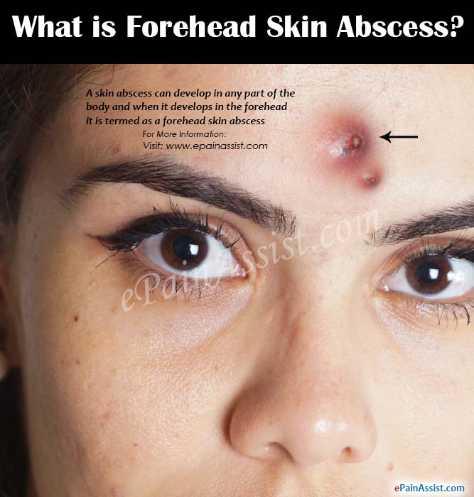 What is Forehead Skin Abscess