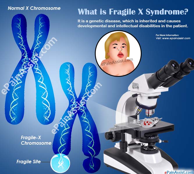 What is Fragile X Syndrome?