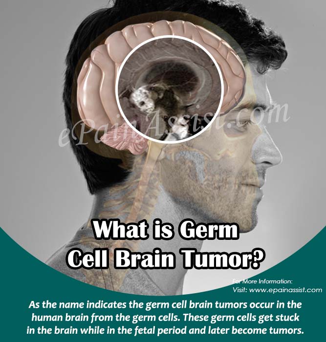 What is Germ Cell Brain Tumor?