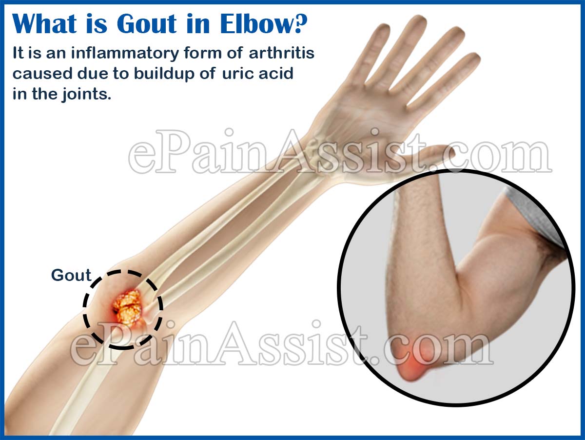 What is Gout in Elbow? What is Gout in Elbow?