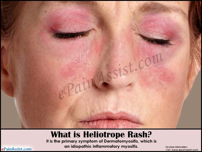 What is Heliotrope Rash?