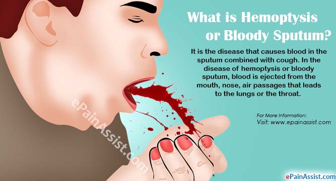 What is Hemoptysis or Bloody Sputum?