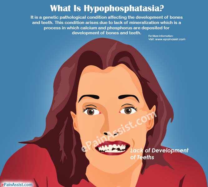 What Is Hypophosphatasia?