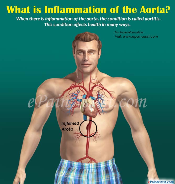 What is Inflammation of the Aorta?