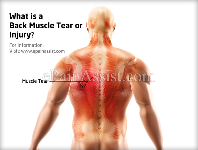 What Is Back Muscle Tear Or Injury How Is It Treated