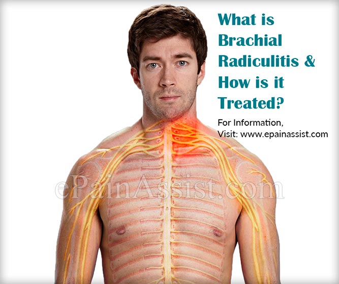 What is Brachial Radiculitis & How is it Treated?