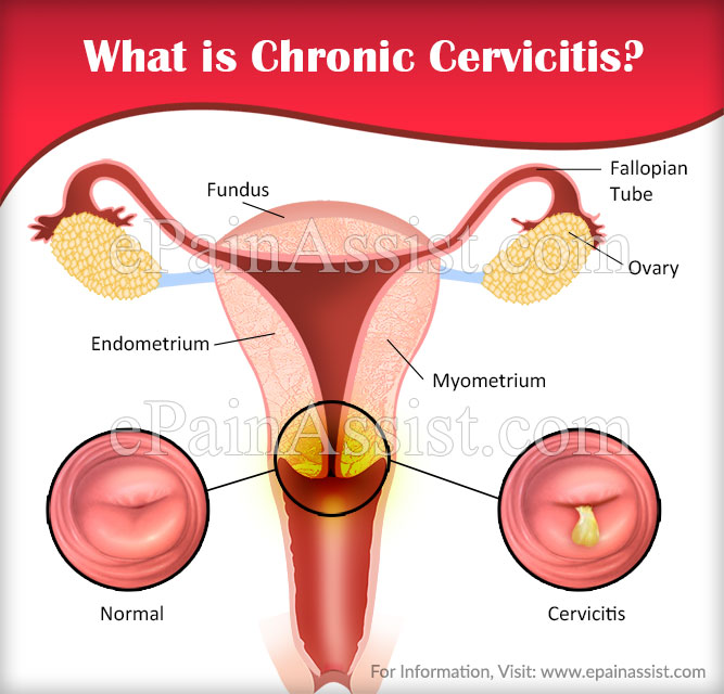 What is Chronic Cervicitis?