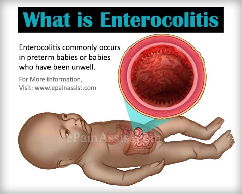 What is Enterocolitis