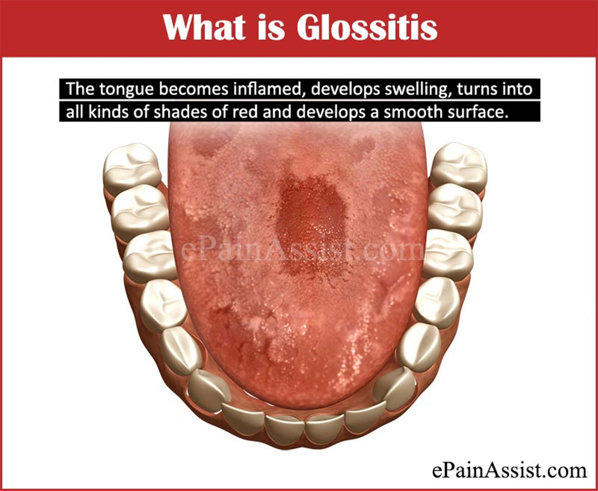 What is Glossitis? What is Glossitis?