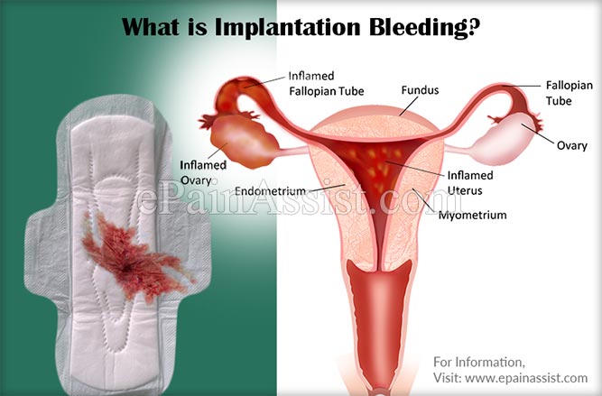 What Is Implantation Bleeding Know Its Causes Symptoms And When To See A Doctor