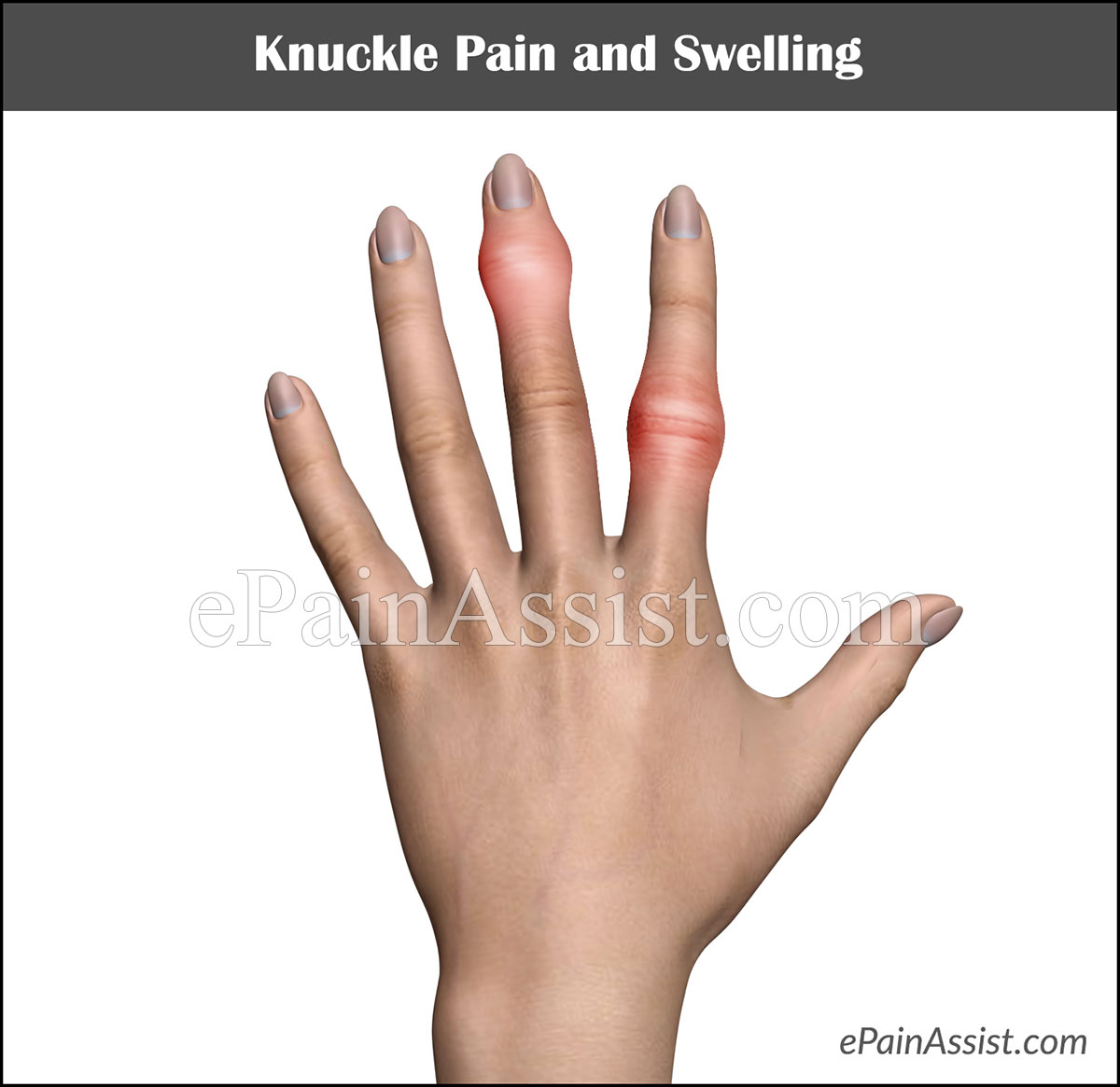What is Knuckle Pain and Swelling? What is Knuckle Pain and Swelling?