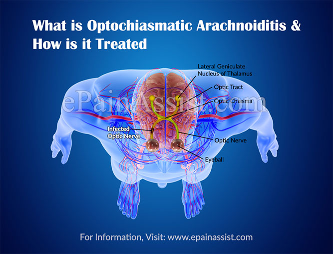 What is Optochiasmatic Arachnoiditis & How is it Treated?