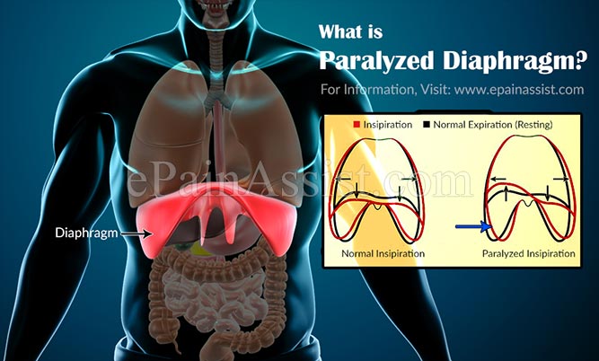 What is Paralyzed Diaphragm?