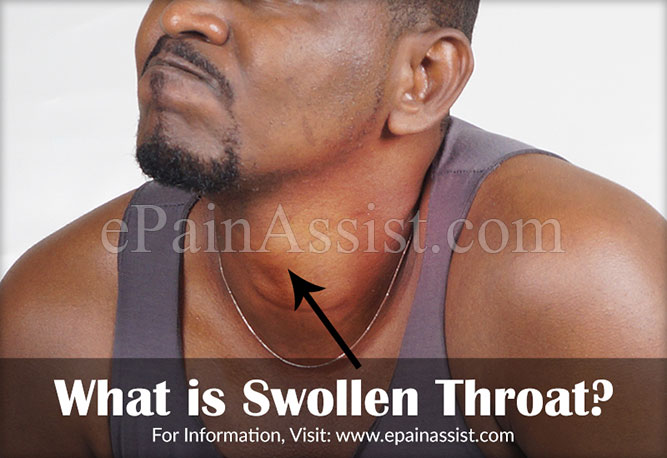 What is Swollen Throat?