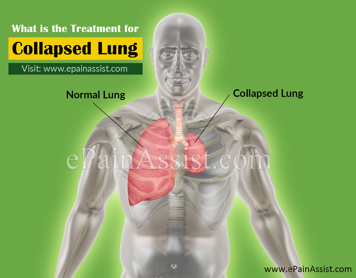 What is the Treatment for Collapsed Lung (CL) or Pneumothorax?