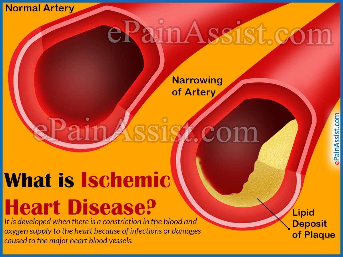 Ischemic Heart Disease Causes Signs Symptoms Diagnosis