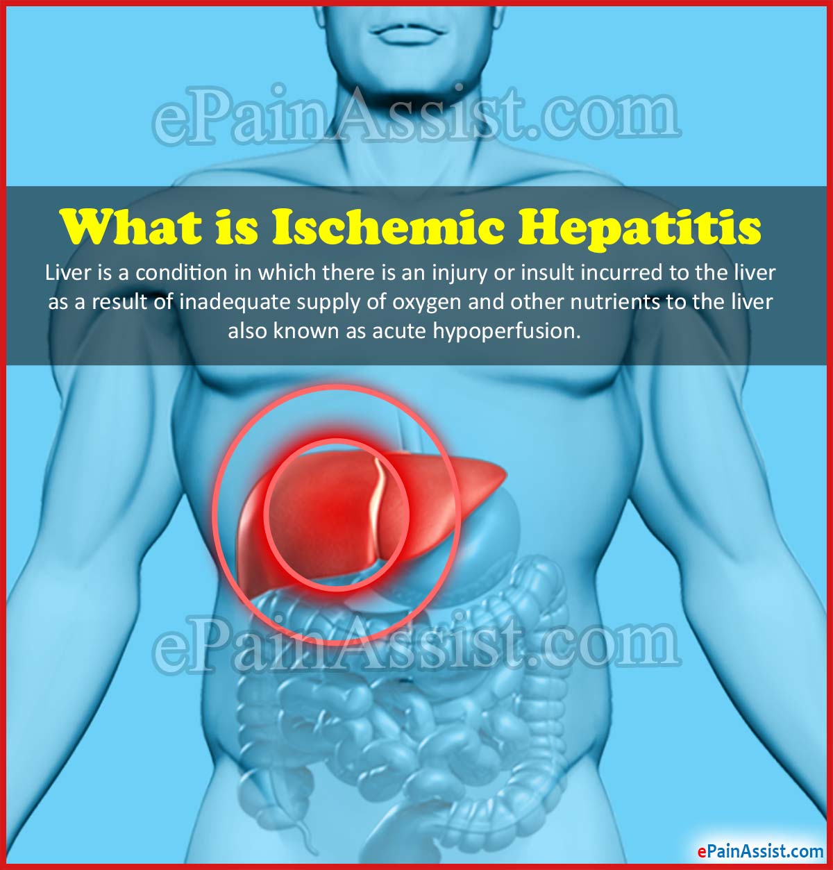 What is Ischemic Hepatitis or Shock Liver?