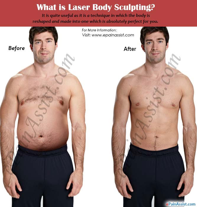 What is Laser Body Sculpting?