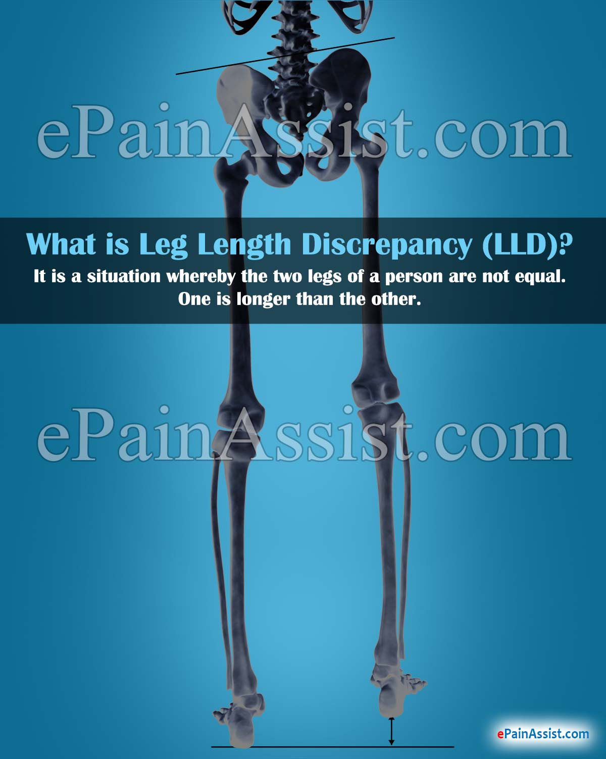 What is Leg Length Discrepancy and How is it Measured? What is Leg Length Discrepancy and How is it Measured?