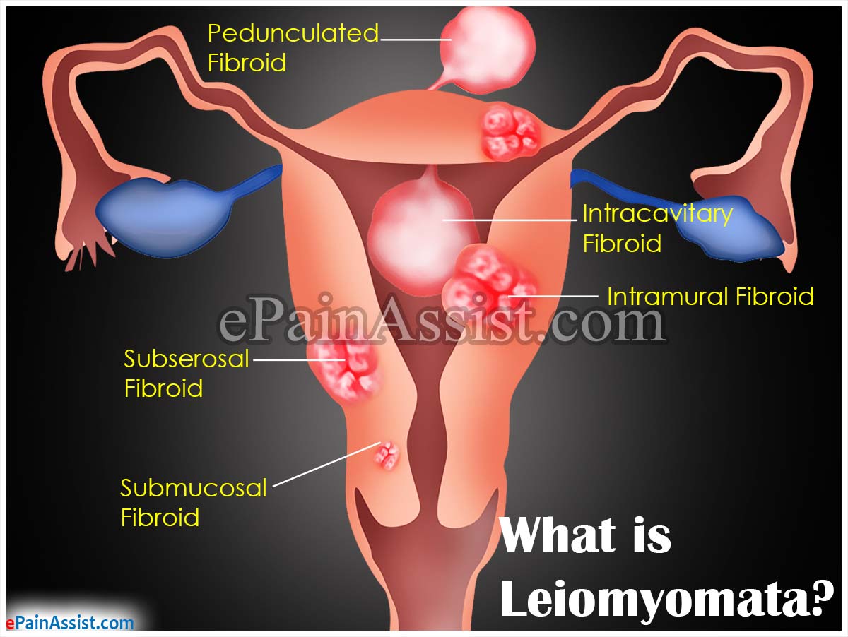 What is Leiomyomata?