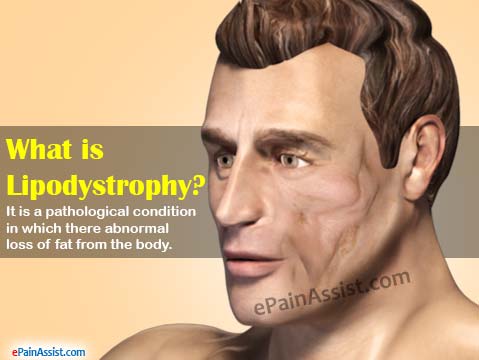 What is Lipodystrophy? What is Lipodystrophy?