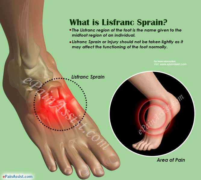 What is Lisfranc Sprain?