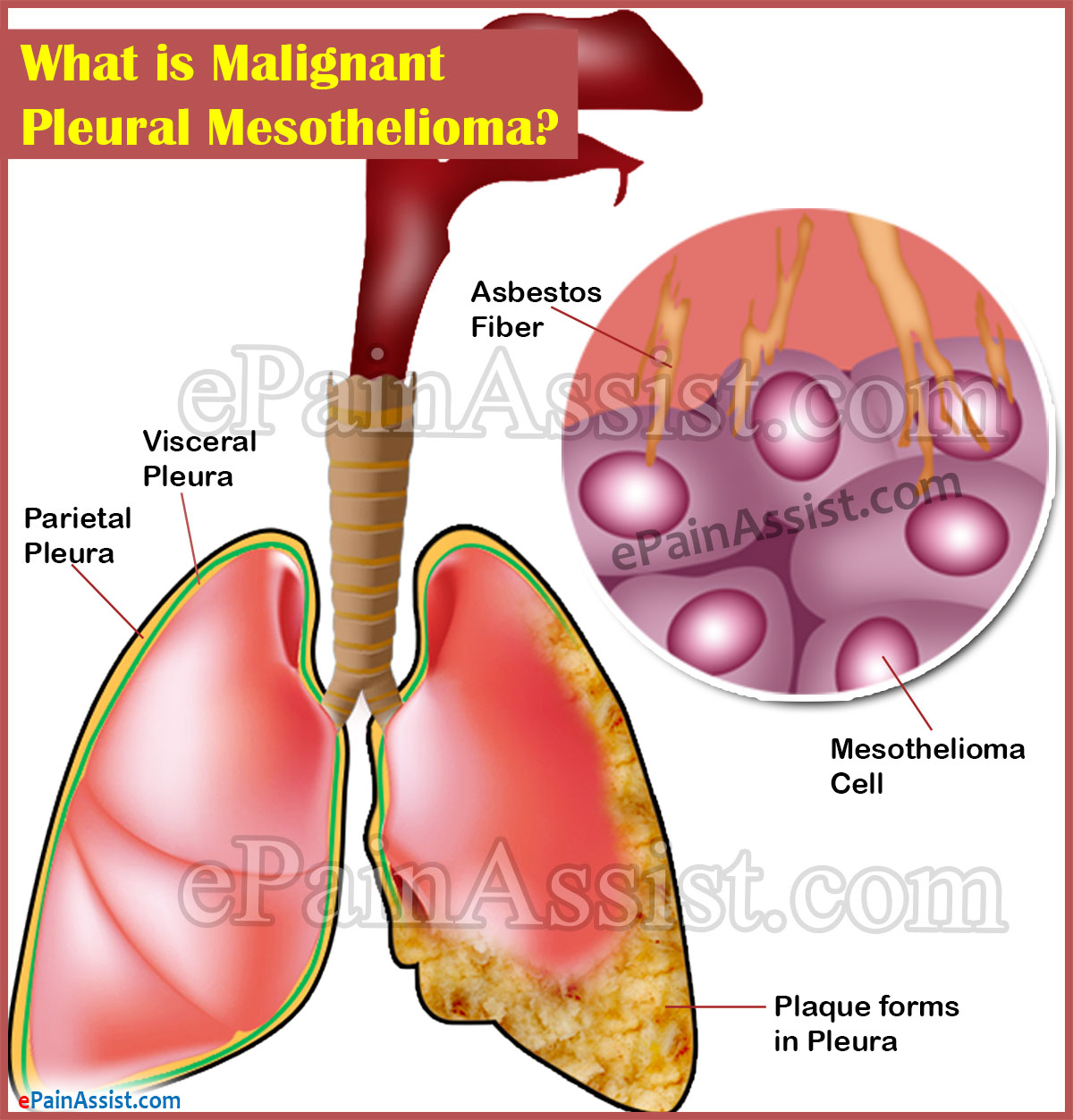 immunohistochemistry of mesothelioma