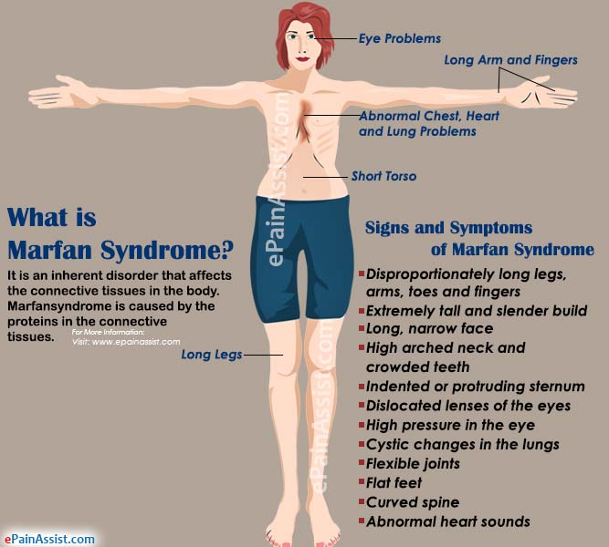 Marfan Syndrome Discovery Marfan Syndrome Discovery