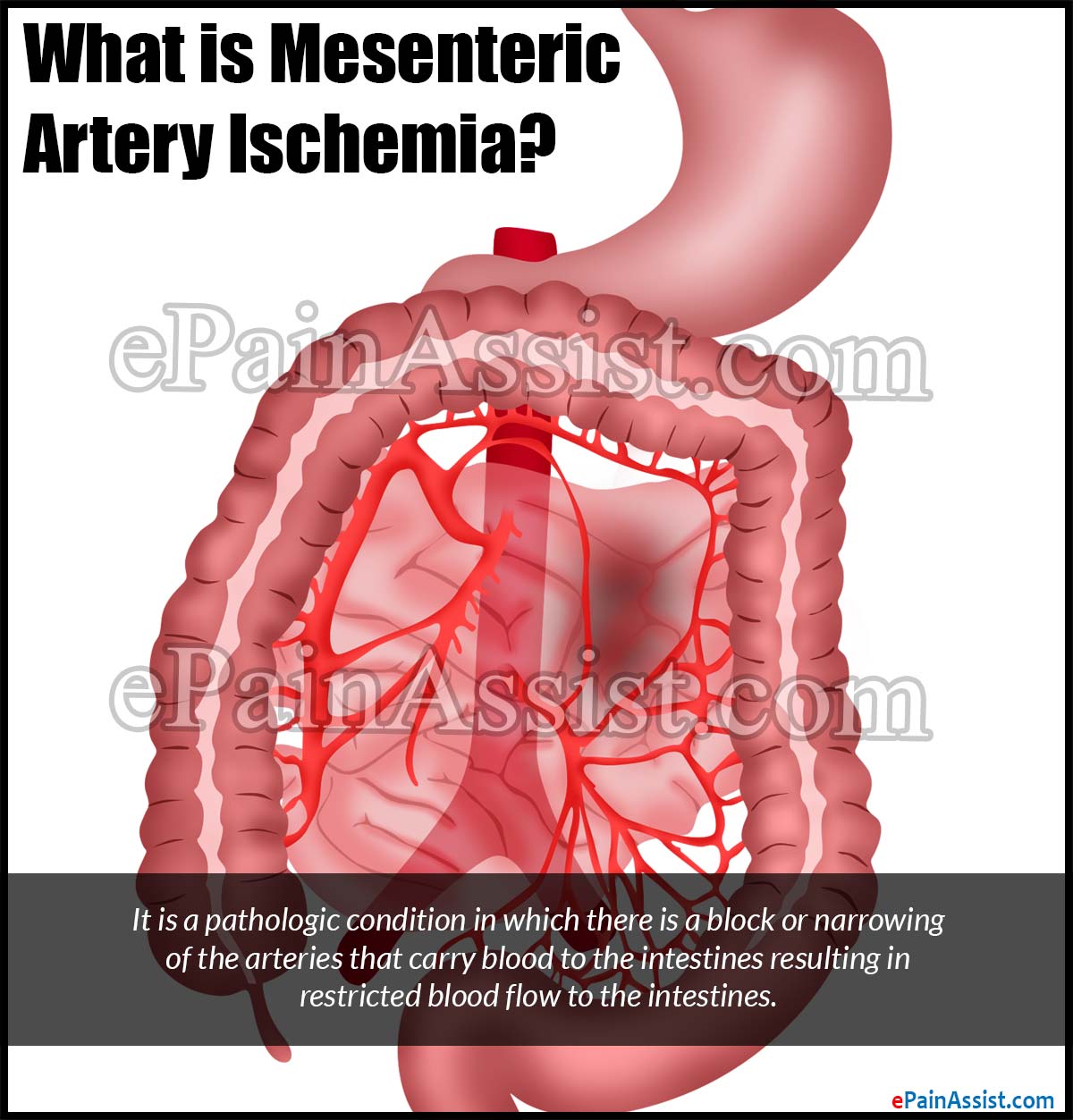 What is Mesenteric Artery Ischemia?