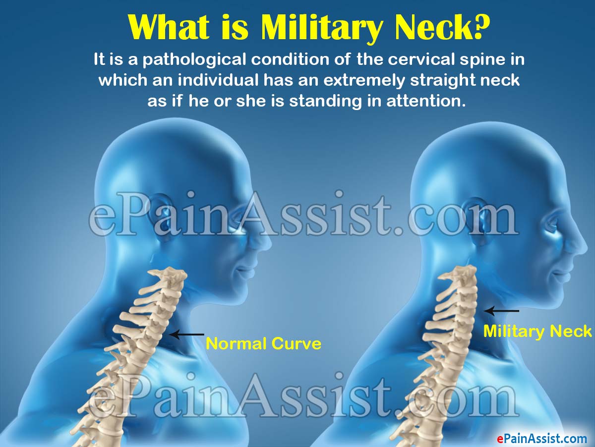 What is Military Neck?