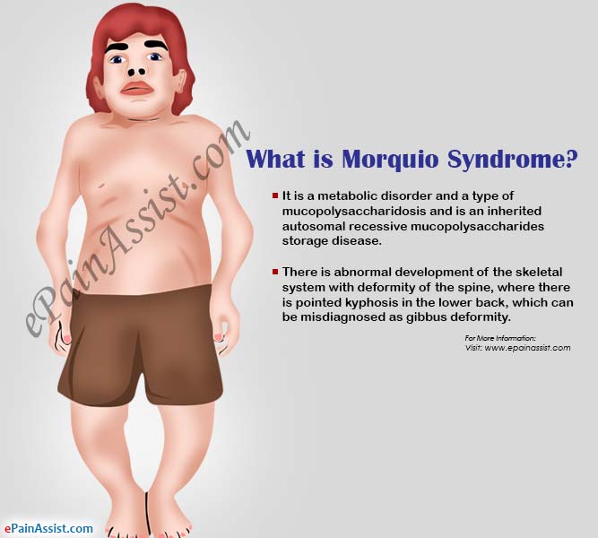 What is Morquio Syndrome?