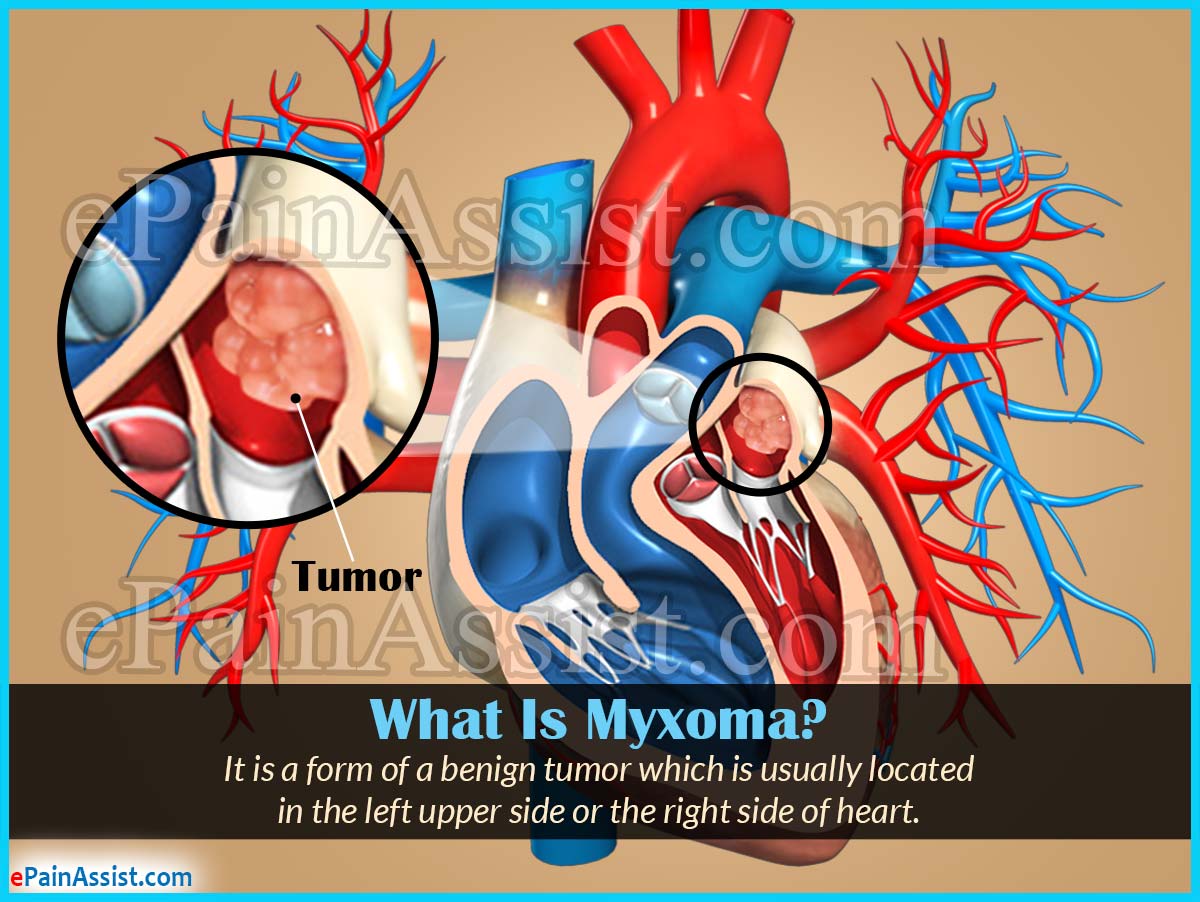 What Is Myxoma?