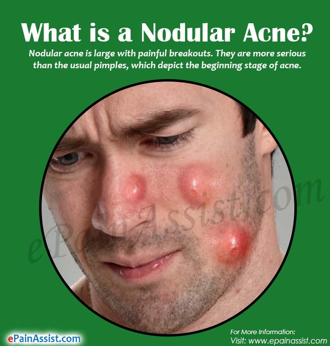 What is a Nodular Acne?