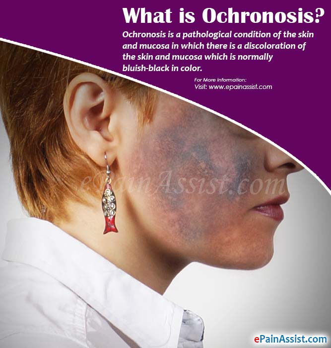 What is Ochronosis?