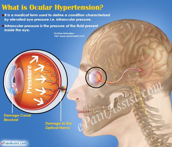 What is Ocular Hypertension?