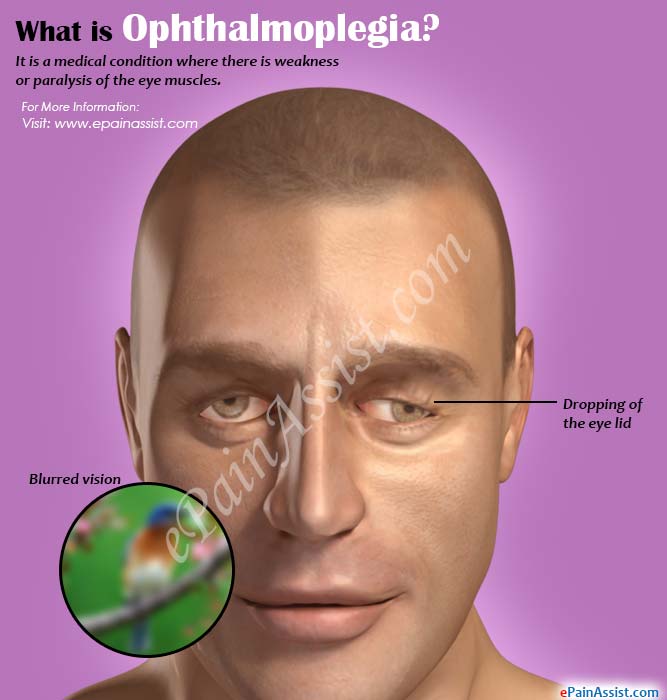 What is Ophthalmoplegia?