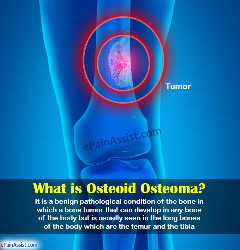 What is Osteoid Osteoma? What is Osteoid Osteoma?