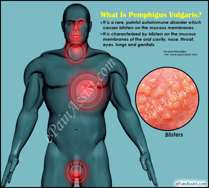 What Is Pemphigus Vulgaris?